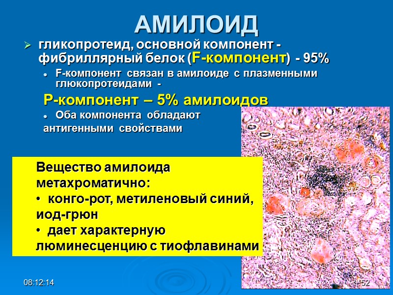 АМИЛОИД гликопротеид, основной компонент - фибриллярный белок (F-компонент) - 95%  F-компонент связан в